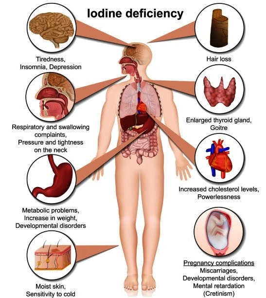 Iodine Deficiency Thyroid In Women 7962